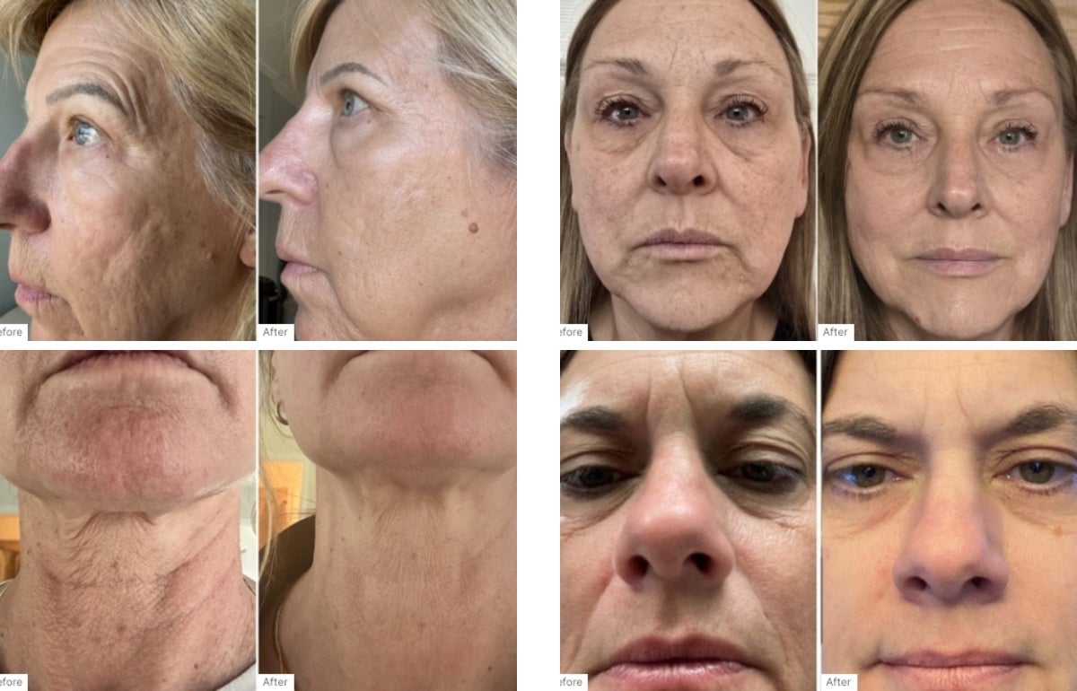A collage of before and after real results of customers that have used the Advanced Skincare Set.