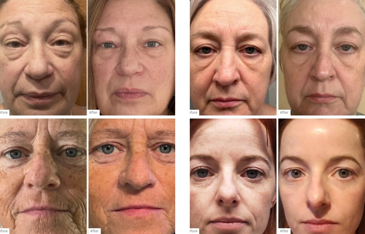 A collage of Before and After Real Results of customers that have used the Fill, Lift & Glow Set.