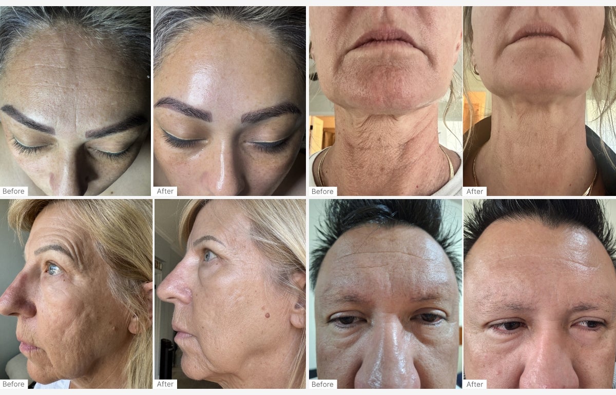 A collage of Before and After Real Results of customers that have used the Radiance Pro Duo.
