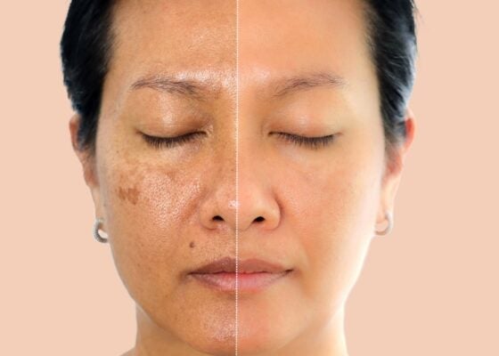 Understanding Sun Spots: Causes, Prevention, and Specific Treatments