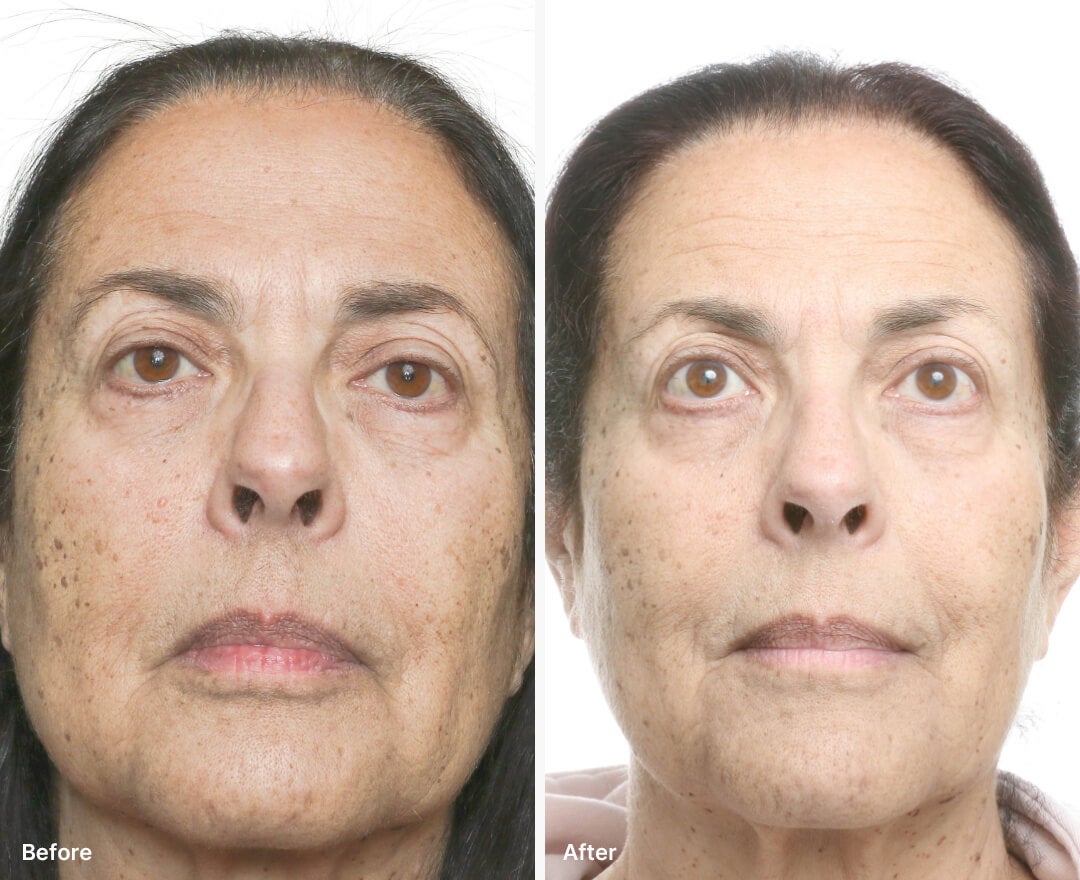 A before and after Real Result of a woman's face after using Neo-FILLER.