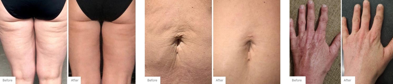 A collage of real results of customers that have used firm body contour cream.
