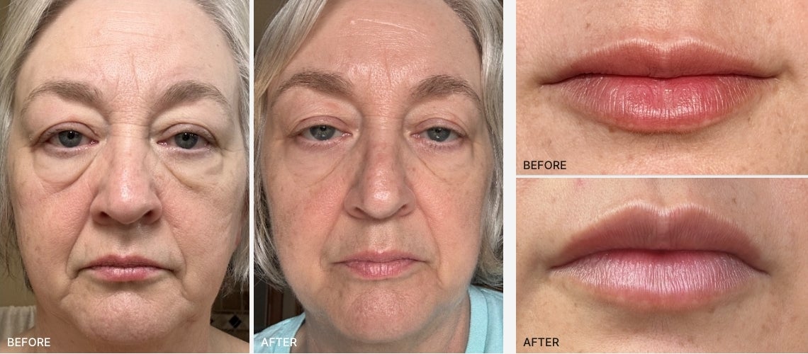Front view comparison of a woman's face before and after cosmetic treatment (left: before, center: after); right shows lip close-ups labeled before (top) and after (bottom).