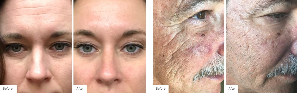 Before and after photos: woman's face shows smoother skin and fewer wrinkles after treatment.