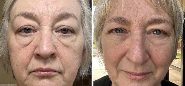 A before and after image of a woman's face.