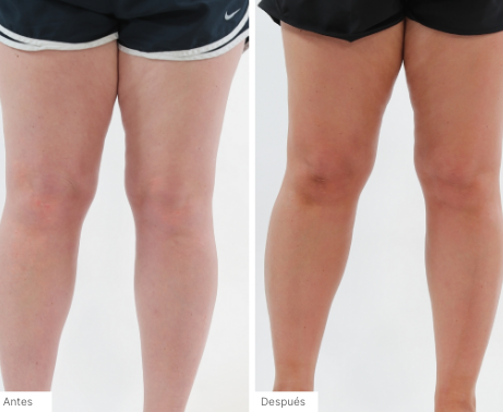 Imágenes de antes y después de personas que han usado el Espuma Autobronceadora 3 en 1 para obtener un bronceado natural y sin rayas