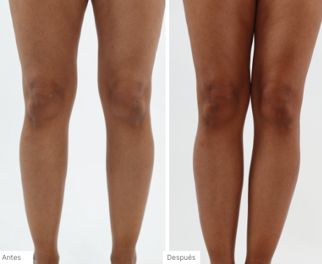 Imágenes de antes y después de personas que han usado el Espuma Autobronceadora 3 en 1 para obtener un bronceado natural y sin rayas