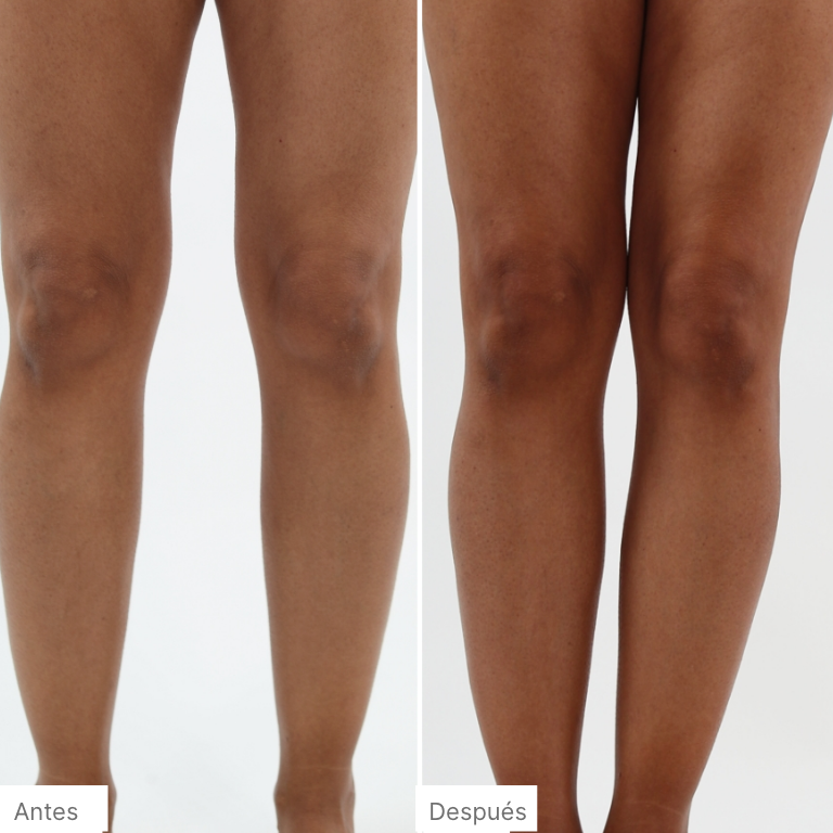 Imagen de antes y después de una mujer que se aplicó el Espuma Autobronceadora + Escultor 3 en 1 en las piernas para realzar su tono natural de piel.